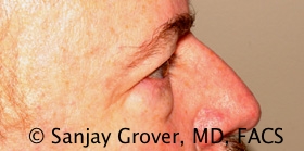 Blepharoplasty Before and After 31 | Grover Aesthetics