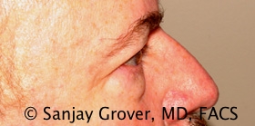 Blepharoplasty Before and After 31 | Sanjay Grover MD FACS