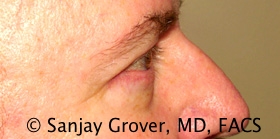 Blepharoplasty Before and After 31 | Sanjay Grover MD FACS