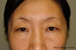 Blepharoplasty Before and After 19 | Sanjay Grover MD FACS