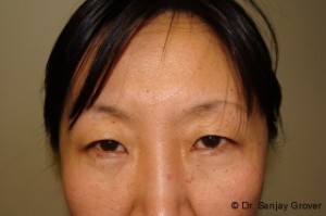 Blepharoplasty Before and After | Sanjay Grover MD FACS