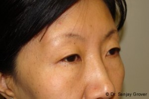 Blepharoplasty Before and After 32 | Grover Aesthetics