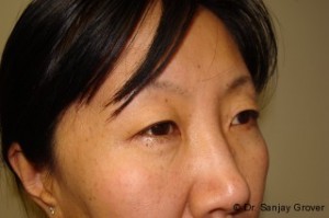 Blepharoplasty Before and After 32 | Grover Aesthetics