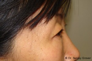 Blepharoplasty Before and After 32 | Grover Aesthetics