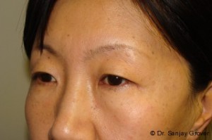 Blepharoplasty Before and After 32 | Sanjay Grover MD FACS