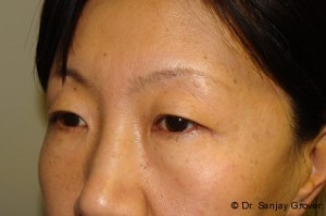 Blepharoplasty Before and After 32 | Grover Aesthetics