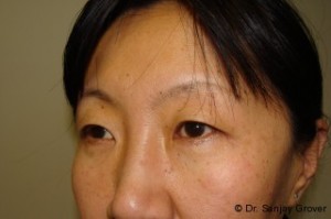 Blepharoplasty Before and After 32 | Sanjay Grover MD FACS