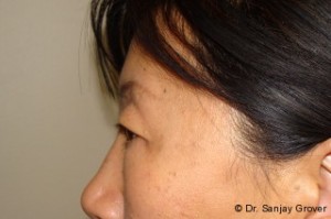 Blepharoplasty Before and After 32 | Grover Aesthetics