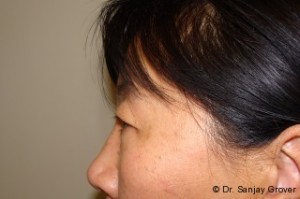 Blepharoplasty Before and After 32 | Grover Aesthetics