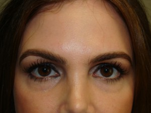 Blepharoplasty Before and After | Grover Aesthetics