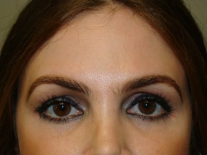 Blepharoplasty Before and After | Grover Aesthetics