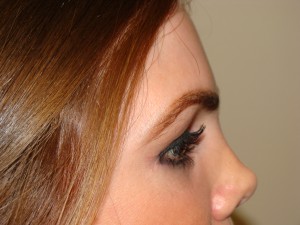 Blepharoplasty Before and After 33 | Grover Aesthetics