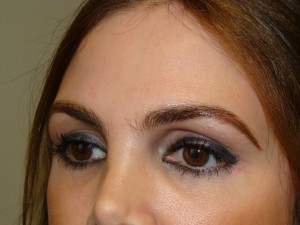 Blepharoplasty Before and After 33 | Grover Aesthetics