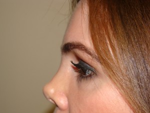 Blepharoplasty Before and After 33 | Grover Aesthetics