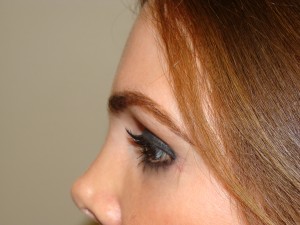 Blepharoplasty Before and After 33 | Grover Aesthetics