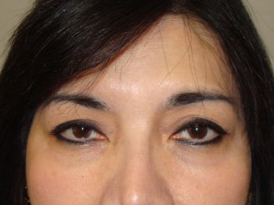 Blepharoplasty Before and After 03 | Sanjay Grover MD FACS