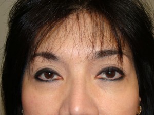 Blepharoplasty Before and After | Grover Aesthetics