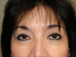 Blepharoplasty Before and After | Sanjay Grover MD FACS