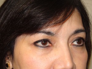 Blepharoplasty Before and After 34 | Sanjay Grover MD FACS