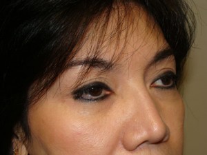 Blepharoplasty Before and After 34 | Sanjay Grover MD FACS