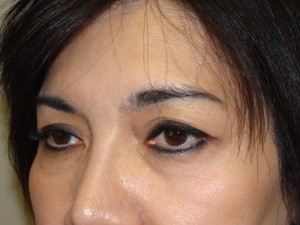 Blepharoplasty Before and After 34 | Sanjay Grover MD FACS