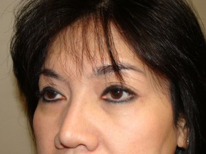 Blepharoplasty Before and After 34 | Sanjay Grover MD FACS