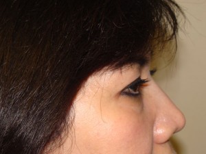 Blepharoplasty Before and After 34 | Grover Aesthetics