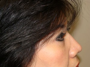 Blepharoplasty Before and After 34 | Grover Aesthetics