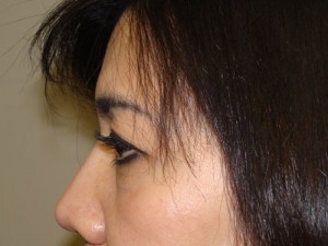 Blepharoplasty Before and After 34 | Grover Aesthetics