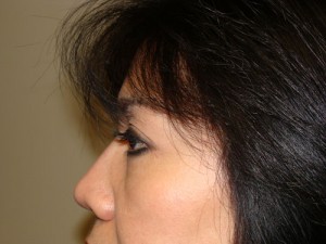Blepharoplasty Before and After 34 | Grover Aesthetics
