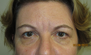 Blepharoplasty Before and After 05 | Sanjay Grover MD FACS