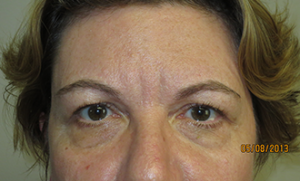 Blepharoplasty Before and After | Grover Aesthetics