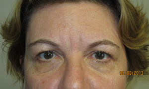 Blepharoplasty Before and After 15 | Sanjay Grover MD FACS