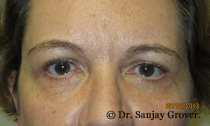 Blepharoplasty Before and After | Grover Aesthetics