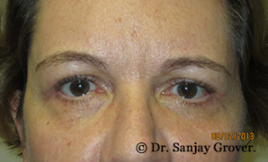 Blepharoplasty Before and After 35 | Sanjay Grover MD FACS