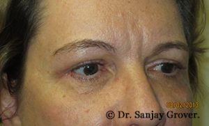 Blepharoplasty Before and After 35 | Sanjay Grover MD FACS
