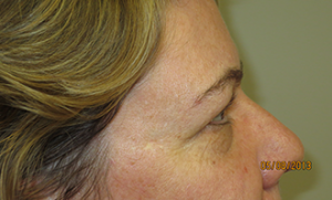 Blepharoplasty Before and After 35 | Grover Aesthetics