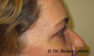 Blepharoplasty Before and After 35 | Grover Aesthetics