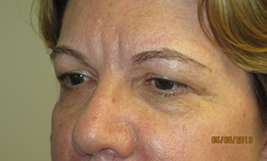 Blepharoplasty Before and After 35 | Sanjay Grover MD FACS