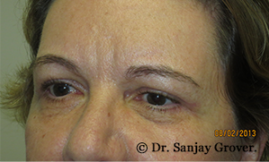 Blepharoplasty Before and After 35 | Sanjay Grover MD FACS