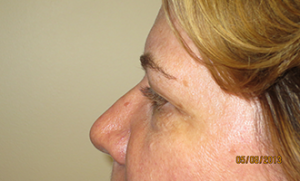 Blepharoplasty Before and After 35 | Grover Aesthetics