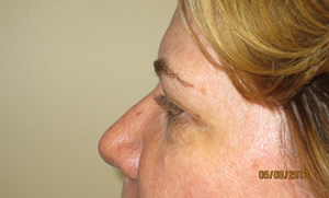 Blepharoplasty Before and After 35 | Sanjay Grover MD FACS