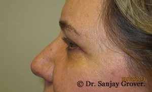 Blepharoplasty Before and After 35 | Sanjay Grover MD FACS