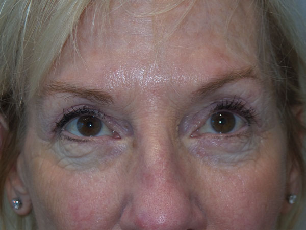 Blepharoplasty Before and After | Grover Aesthetics