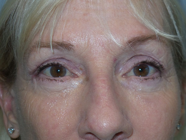 Blepharoplasty Before and After | Grover Aesthetics
