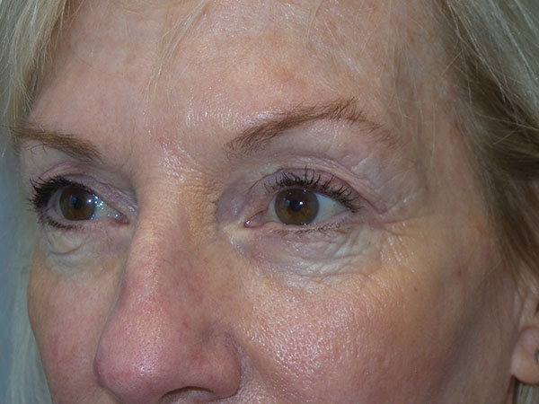 Blepharoplasty Before and After 36 | Grover Aesthetics