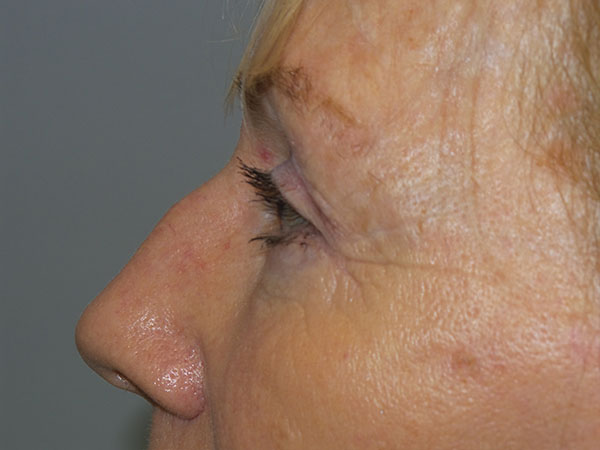 Blepharoplasty Before and After 36 | Sanjay Grover MD FACS