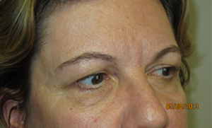 Blepharoplasty Before and After 37 | Grover Aesthetics