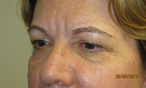 Blepharoplasty Before and After 37 | Grover Aesthetics