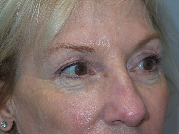 Blepharoplasty Before and After 38 | Grover Aesthetics